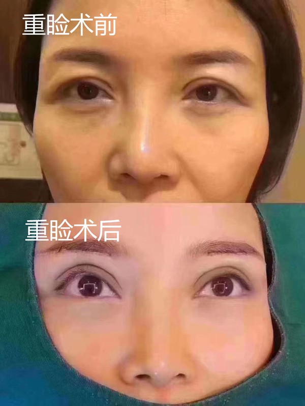 重睑术_副本.jpg