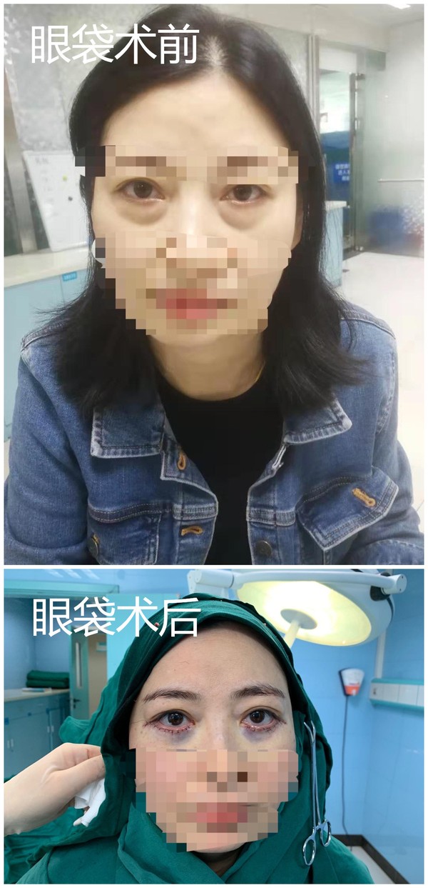 眼袋术后_副本.jpg