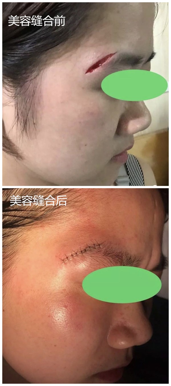 美容缝合前_副本.jpg