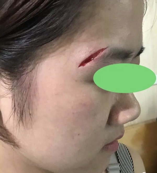 美容缝合前.jpg
