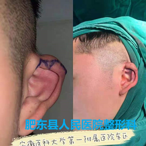 术前术中比较.jpg
