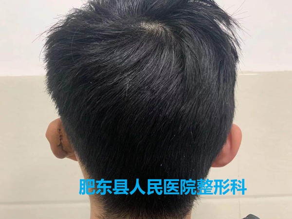 术后背面.jpg